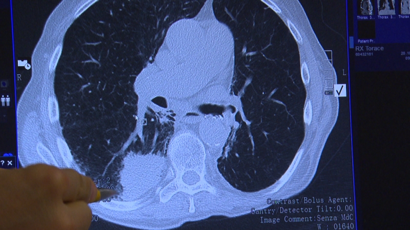 Bild eines Lungentumors